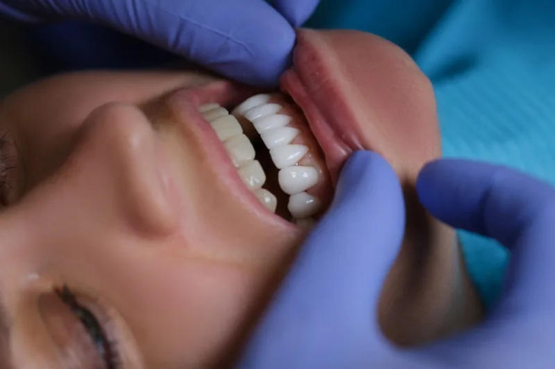 GN Dental Yuba City | Composite Veneers GN Dental Yuba City | Composite Veneers