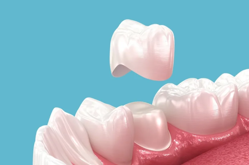 GN Dental Yuba City | Dental Crowns & Bridges GN Dental Yuba City | Dental Crowns & Bridges