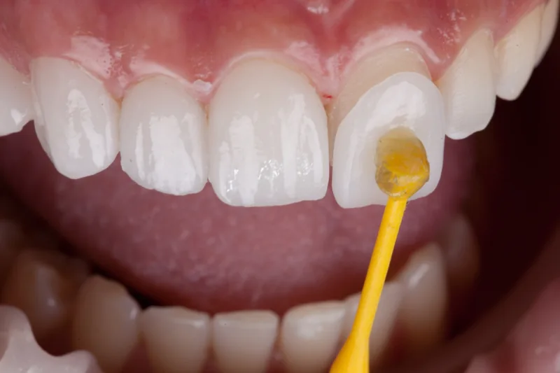GN Dental Yuba City | Porcelain Veneers