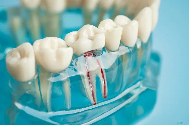 GN Dental Yuba City | Root Canal Therapy GN Dental Yuba City | Root Canal Therapy