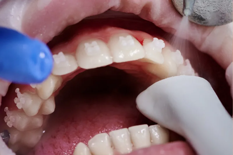 GN Dental Yuba City | Teeth Whitening / Cleaning GN Dental Yuba City | Teeth Whitening / Cleaning