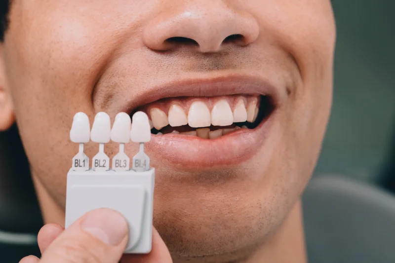 GN Dental Yuba City | Veneers GN Dental Yuba City | Veneers