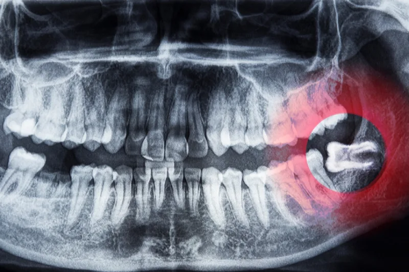 GN Dental Yuba City | Wisdom Teeth Removal GN Dental Yuba City | Wisdom Teeth Removal
