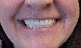 GN Dental Yuba City | Implant GN Dental Yuba City | Implant