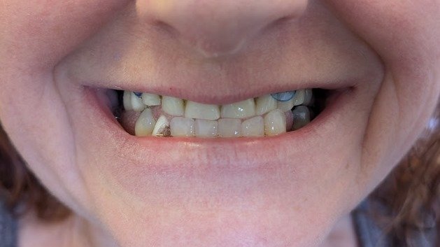 GN Dental Yuba City | Implant