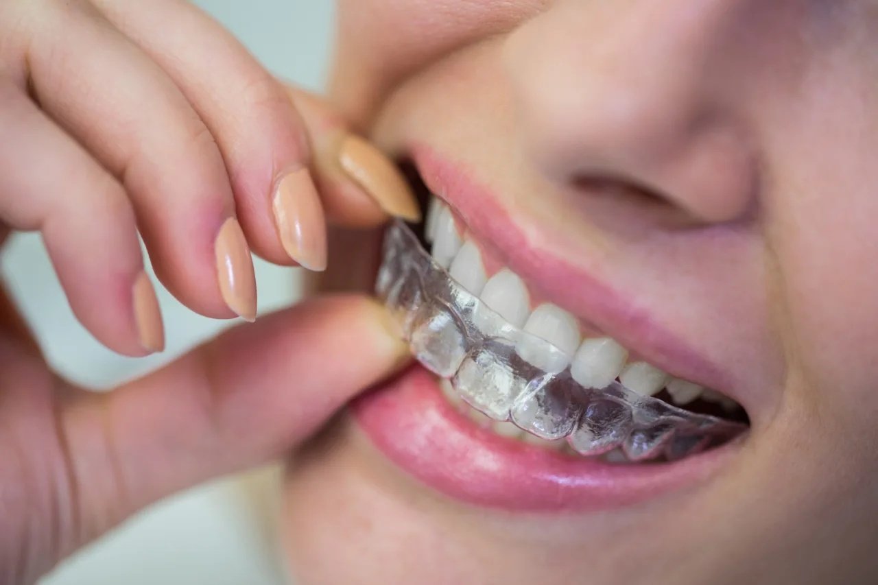 GN Dental Yuba City | Invisalign GN Dental Yuba City | Invisalign