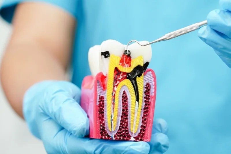GN Dental Yuba City | Root Canal Therapy GN Dental Yuba City | Root Canal Therapy