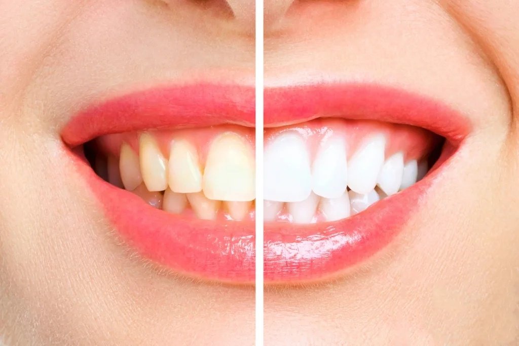 GN Dental Yuba City | Teeth Whitening / Cleaning GN Dental Yuba City | Teeth Whitening / Cleaning