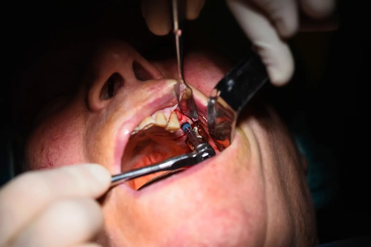 GN Dental Yuba City | Wisdom Teeth Removal GN Dental Yuba City | Wisdom Teeth Removal