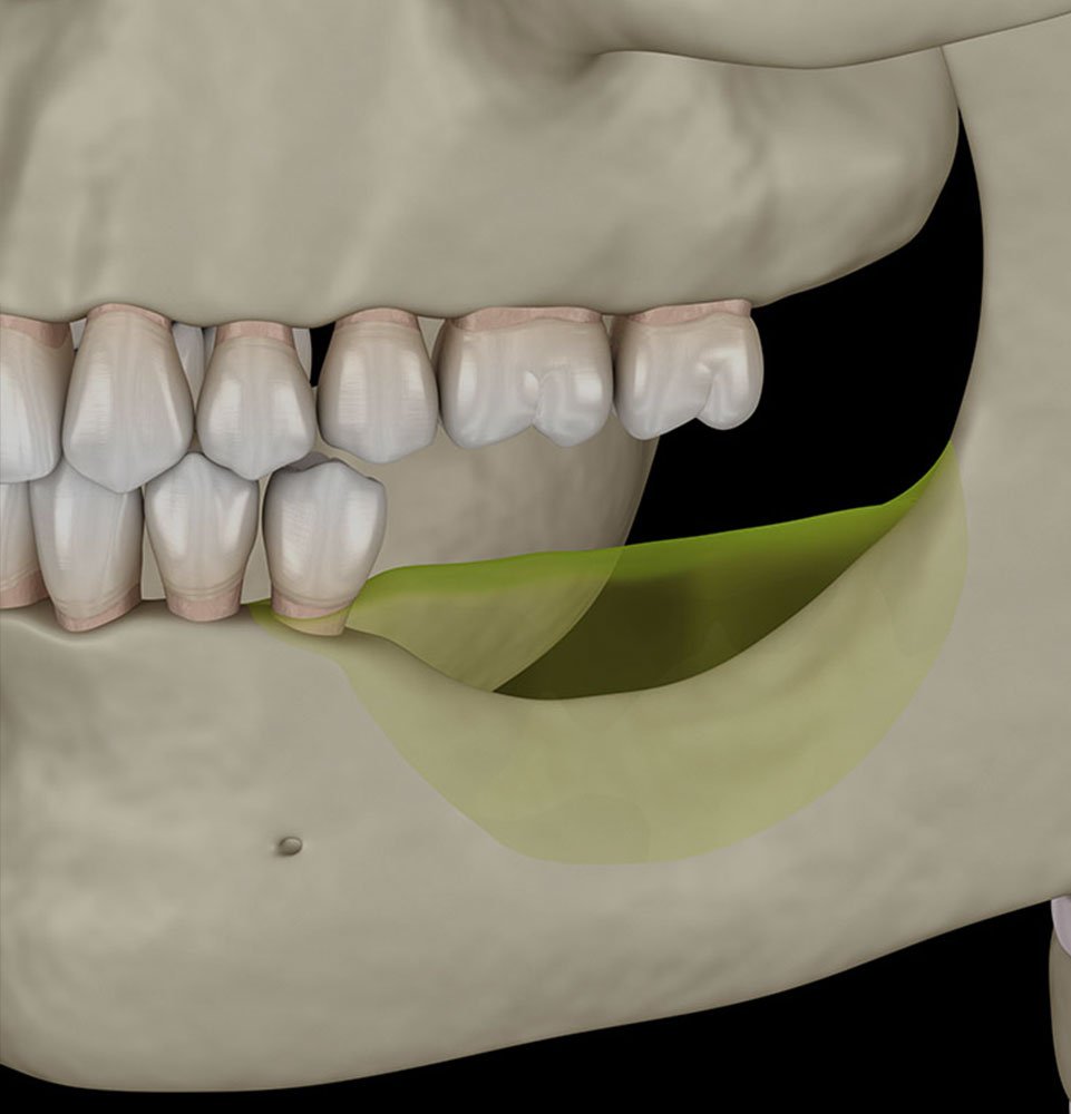 GN Dental Yuba City | Implant GN Dental Yuba City | Implant