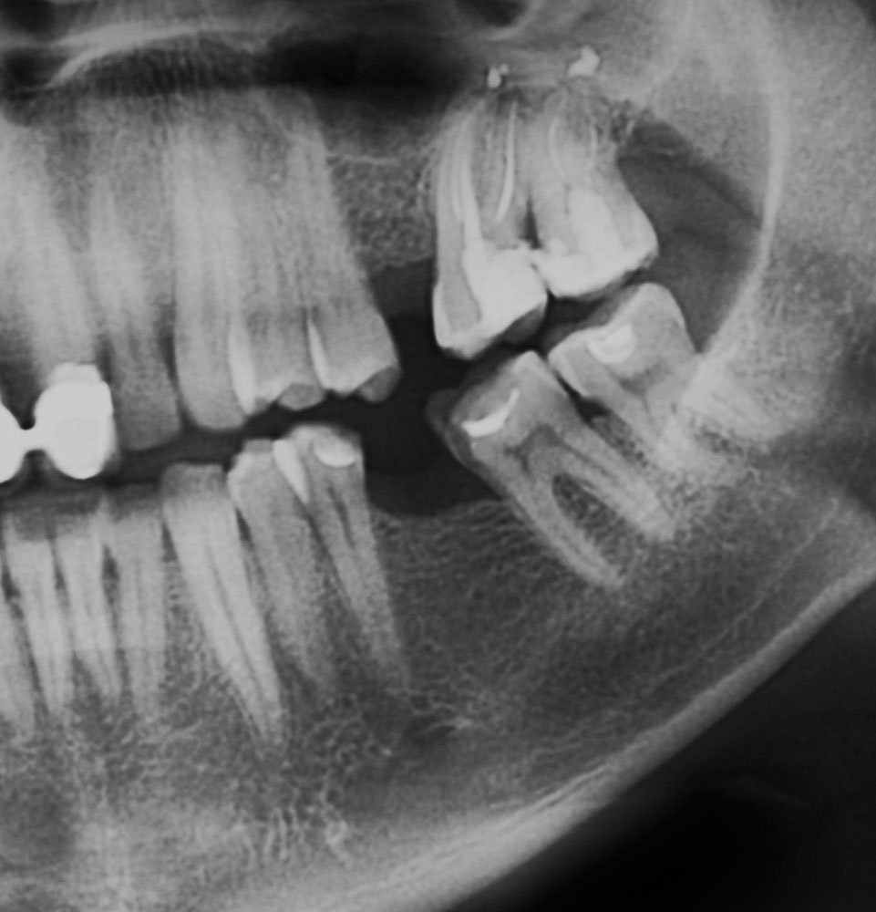 GN Dental Yuba City | Implant GN Dental Yuba City | Implant